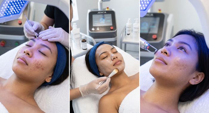 JENCA Acne Clear Reset facial